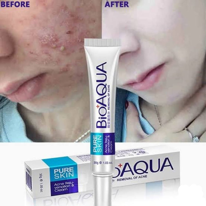 BIOAQUA Anti Acne Cream Acne Scar Removal Cream | Best Quality